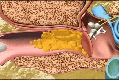 Електрически уред за почистване на ушна кал - Aurivioo™