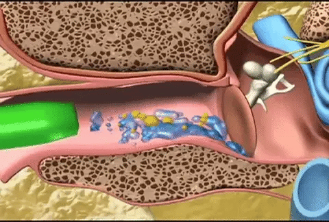 Електрически уред за почистване на ушна кал - Aurivioo™